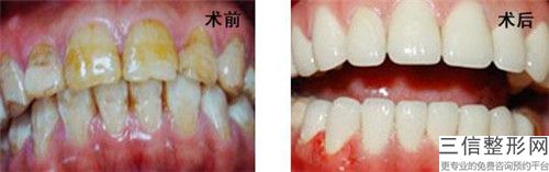 韶關(guān)全口百丹特種植牙的價(jià)格大致在什么范圍