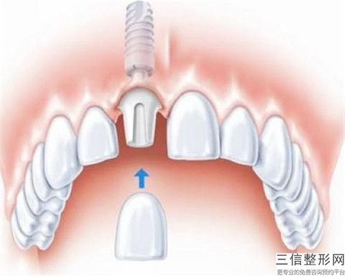 河池牙齒連橋修復的費用受到什么因素的影響