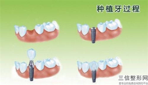 朝陽氧化鋯全瓷牙價格多少錢左右