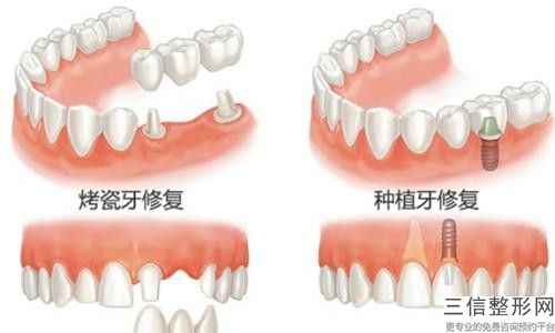 漳州純鈦鋼牙套的價格由那些因素決定