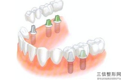 紹興華西種植牙手術需要的價格