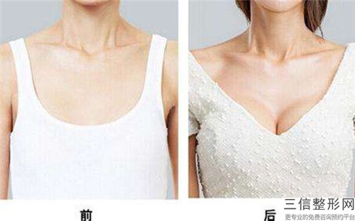 安慶縮小乳頭乳暈手術(shù)適宜與禁忌人群