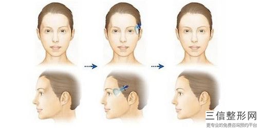南通市脂肪體太陽穴填充價格價位表掛號容易嗎醫院實力附(脂肪體太陽穴填充均價為：4246元)