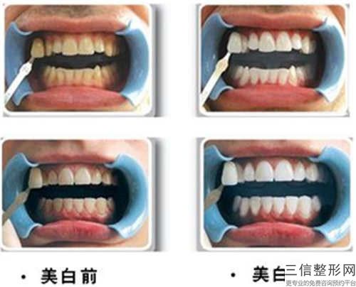 雙鴨山即刻負重種植牙做完多長時間可以看到效果