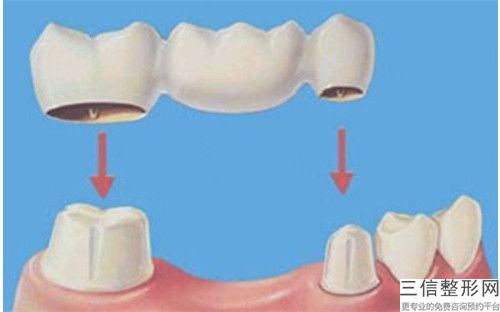 錫林郭勒固定搭橋修復牙齒手術方法及適應人群