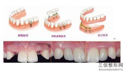 梅州牙齒纖維帶固定的優點和適應人群