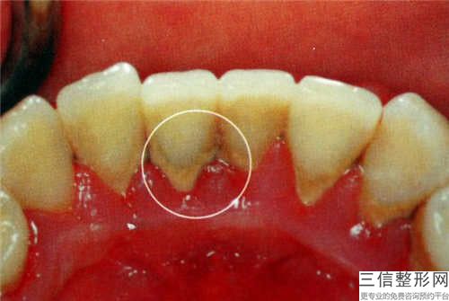 重慶烤瓷牙崩瓷樹脂修復整形適合什么樣的人做哪里靠譜