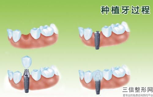 錦州豐樂口腔門診部牙冠缺損修復后3項護理