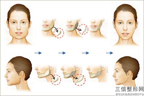 面部抽脂雙下巴醫(yī)院推薦：面部抽脂雙下巴醫(yī)院前20位
