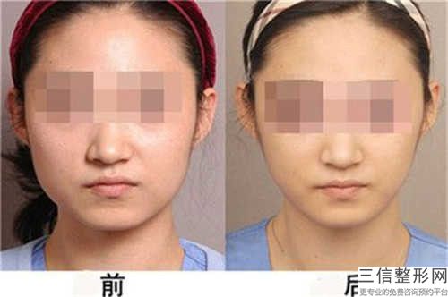 開頜正頜手術醫院推薦：開頜正頜醫院前20名哪家名氣高