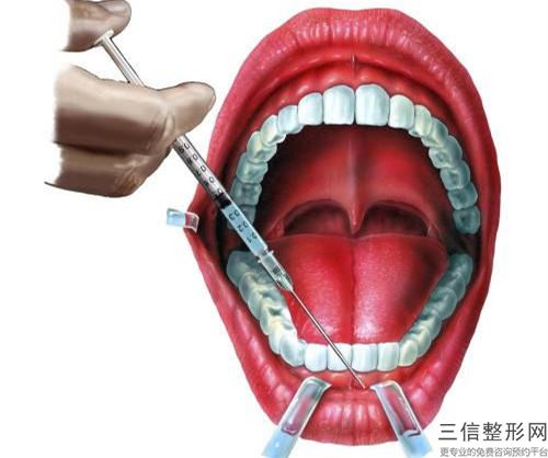 滄州門(mén)牙即刻種植牙齦萎縮要注意哪些副作用問(wèn)題