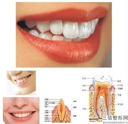 張賓烤瓷牙樹脂修復美容可以維持多久