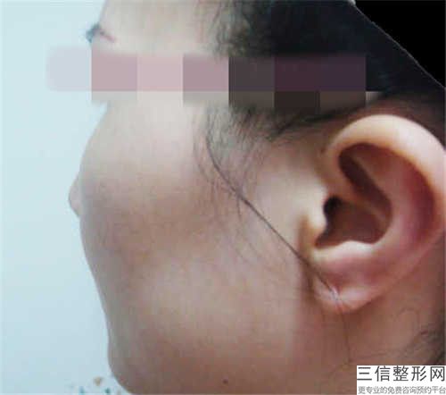 延邊顴骨磨骨內推影響以后生育哺乳嗎