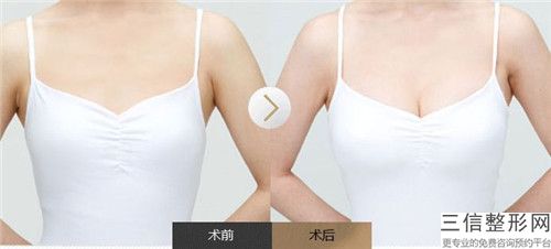 淮北乳暈縮小術對人體皮膚有什么危害嗎