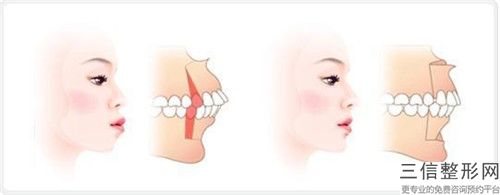 廣州梅里奧口腔門診部恒牙固定整形存在的風險大嗎