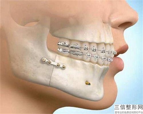 杭州雍禾植發醫院水冷激光牙齒治療手術的效果及術后護理