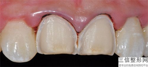 上海恒佳口腔門診部牙齒黑三角修復(fù)安全不安全