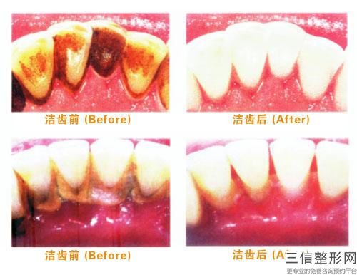 通遼門牙連橋冠有后遺癥嗎_通遼門牙連橋冠會有后遺癥出現嗎