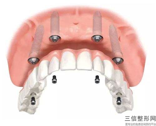 重慶大坪總院兒童門牙導萌術會影響懷孕和分娩嗎