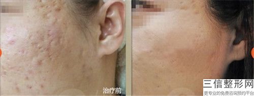 夏天整形美容價(jià)格表大全-果酸換膚去雀斑案例