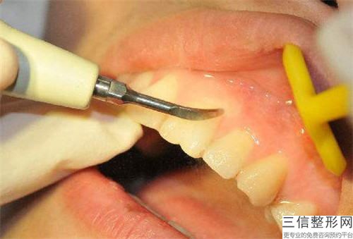 宜賓牙周炎治療術大致費用是多少