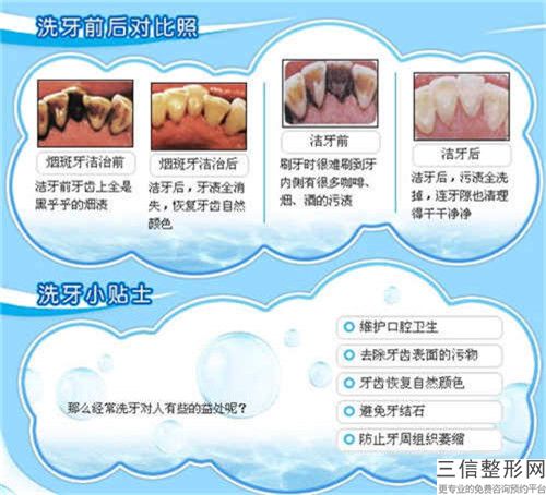 隨州單人煙漬、茶漬、黃牙清洗有沒效果