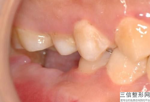 柳州和平醫院整形外科上門牙埋伏牙開窗手術有不良反應出現嗎