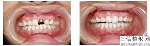 齊齊哈爾牙齒種植整形一般適合哪些人群做