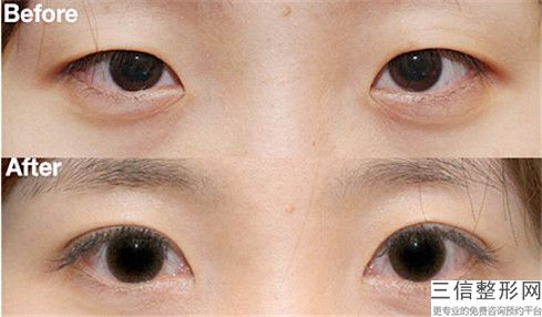 梧州眼角切開手術整容安不安全