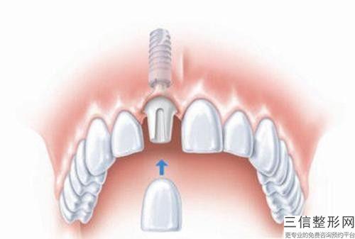 煙臺牙冠受損手術的效果與價格
