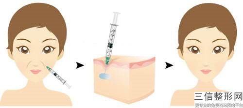 葫蘆島激光磨削除皺術矯正的治療方法與效果