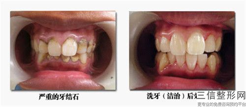 眉山前牙美容修復術術四大后遺癥