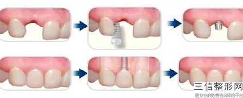 保山種植牙失敗修復手術會不會有后遺癥,