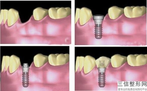 蚌埠微創種植牙對身體會產生什么傷害