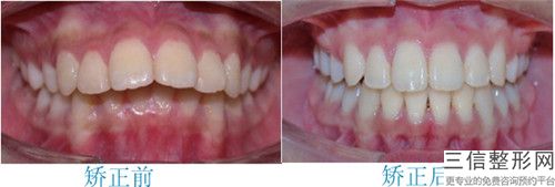 兔牙矯正的術后效果怎么樣