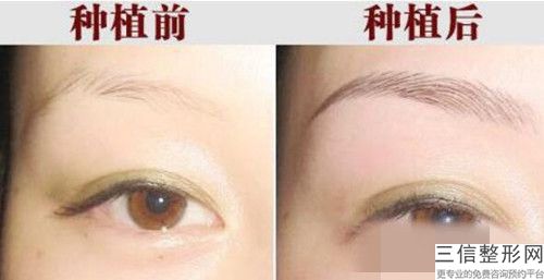 朔州麗航國際醫療美容醫院價位表查看-理發修眉案例