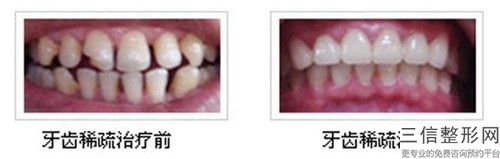 珠海emax全瓷牙矯正后要如何護理