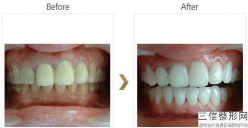 德陽美牙冠手術(shù)后多久可以見到效果