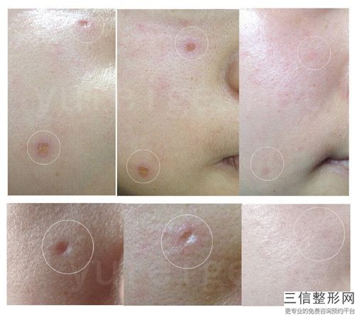 中國彩光嫩膚去痘痘權威醫院：彩光嫩膚去痘痘醫院50強正規人氣機構