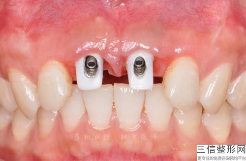 滁州牙齒固定橋到底安不安全-滁州牙齒固定橋安不安全有副作用嗎