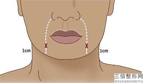 七臺(tái)河國(guó)產(chǎn)除皺手術(shù)安全受什么因素影響