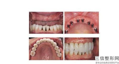 咸寧種植牙埋入式前后對比效果很明顯嗎