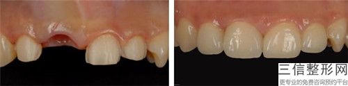威海牙齒全冠修復手術有什么不良后果