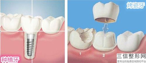 來賓齲齒補牙用什么美容方法比較有效