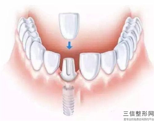 阜陽3D美容冠美牙會影響生育嗎