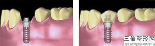 韓國種登騰Dentium種植牙對身體有沒有什么壞處