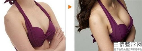 國內去副乳手術醫院推薦：去副乳手術醫院top50強權威盤點