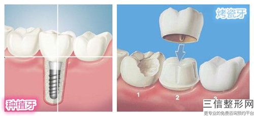 資陽半口拓美種植牙手術(shù)的效果特點