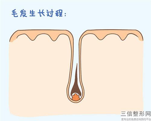 醫美之毛發移植功效_毛發移植手術后多久美化效果更佳