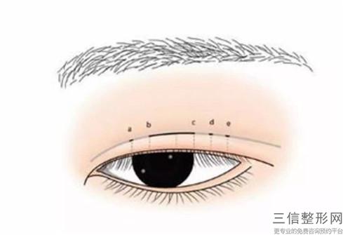 做超聲波解決黑眼圈多長時間可以看到效果